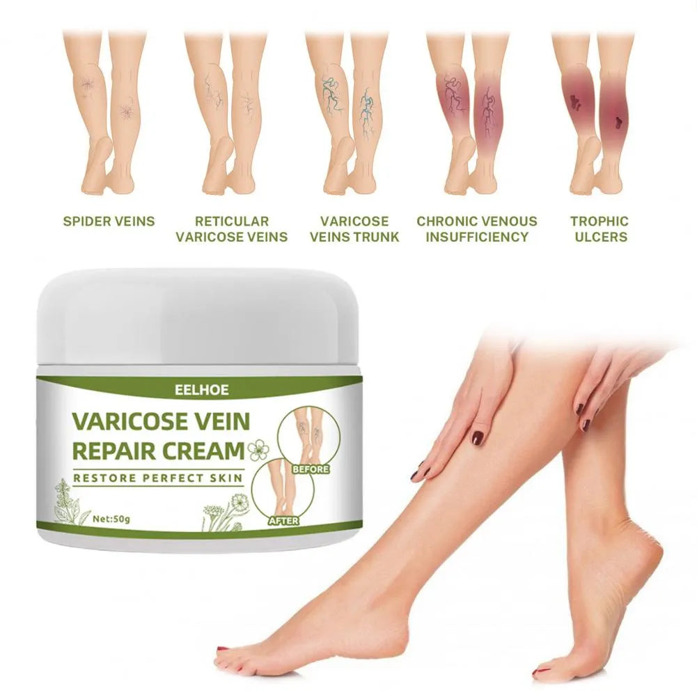 Varicose Veins Cream