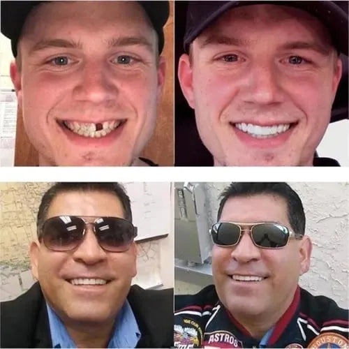 Official Brand Store - EeihoeTMAdjustable Snap-On Dentures