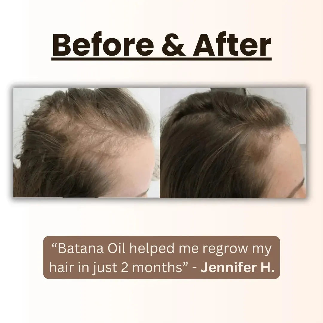 💯[Official Brand Store]- 🌿Natural Herbal Handcrafted Batana Oil Hair Growth Blend