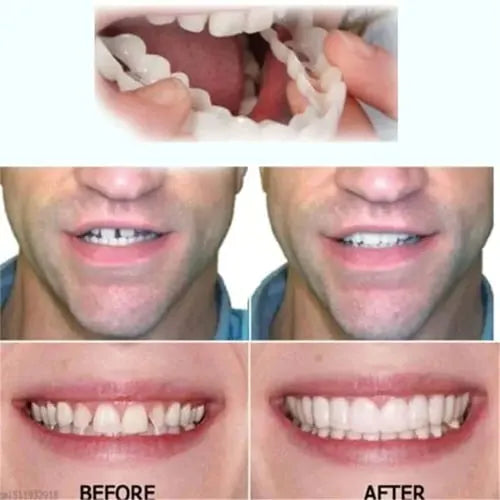 Official Brand Store - EeihoeTMAdjustable Snap-On Dentures