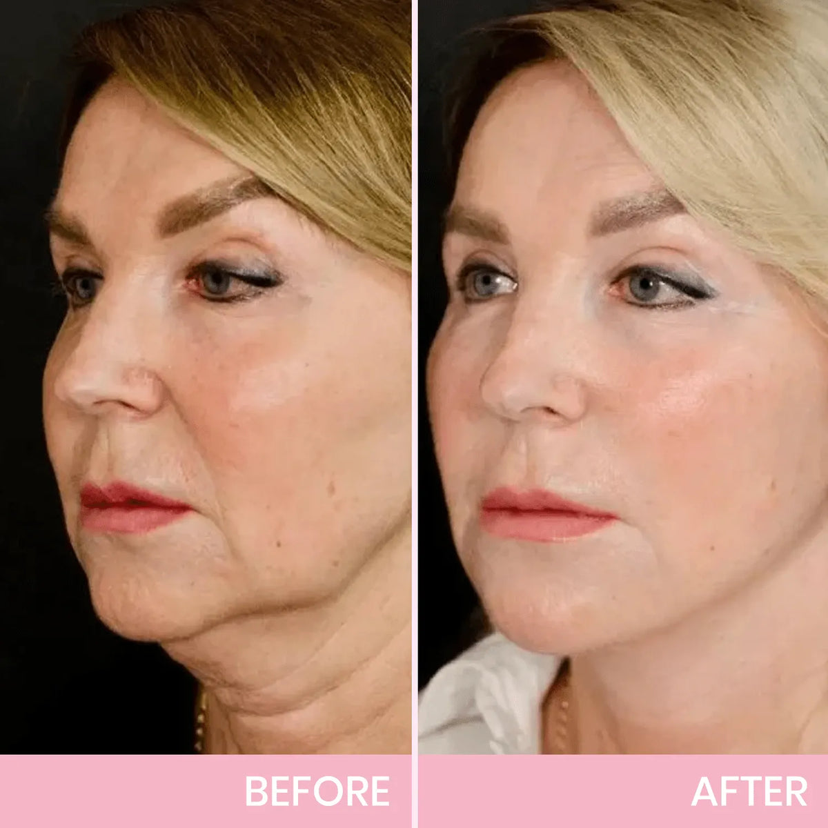 🔥HOT SALE🔥V-Face👑 Lifting Invisible Adhesive Tape