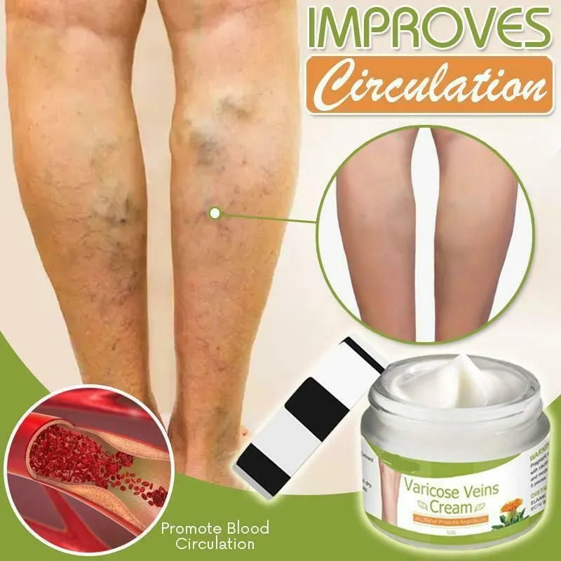 Varicose Veins Cream