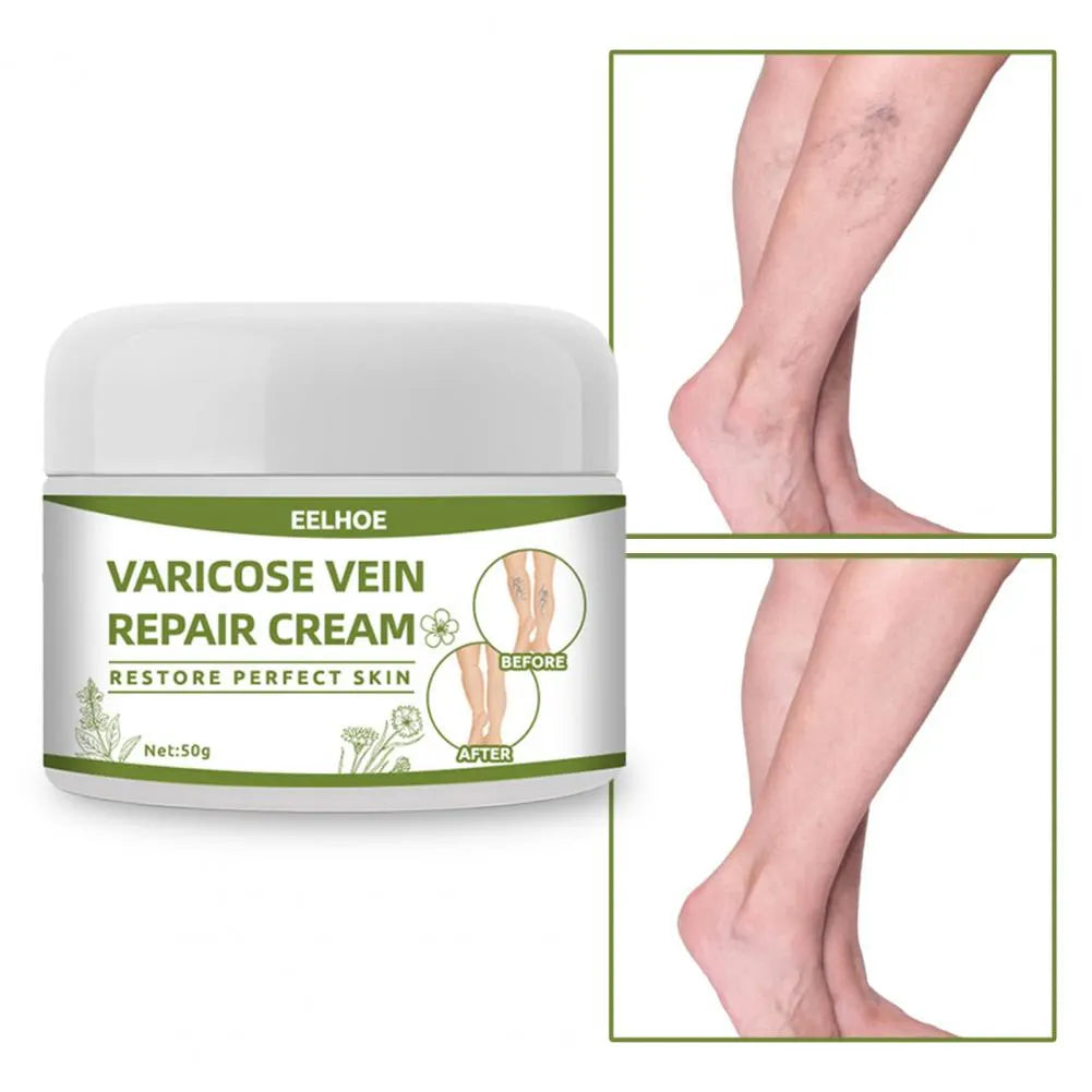 Varicose Veins Cream