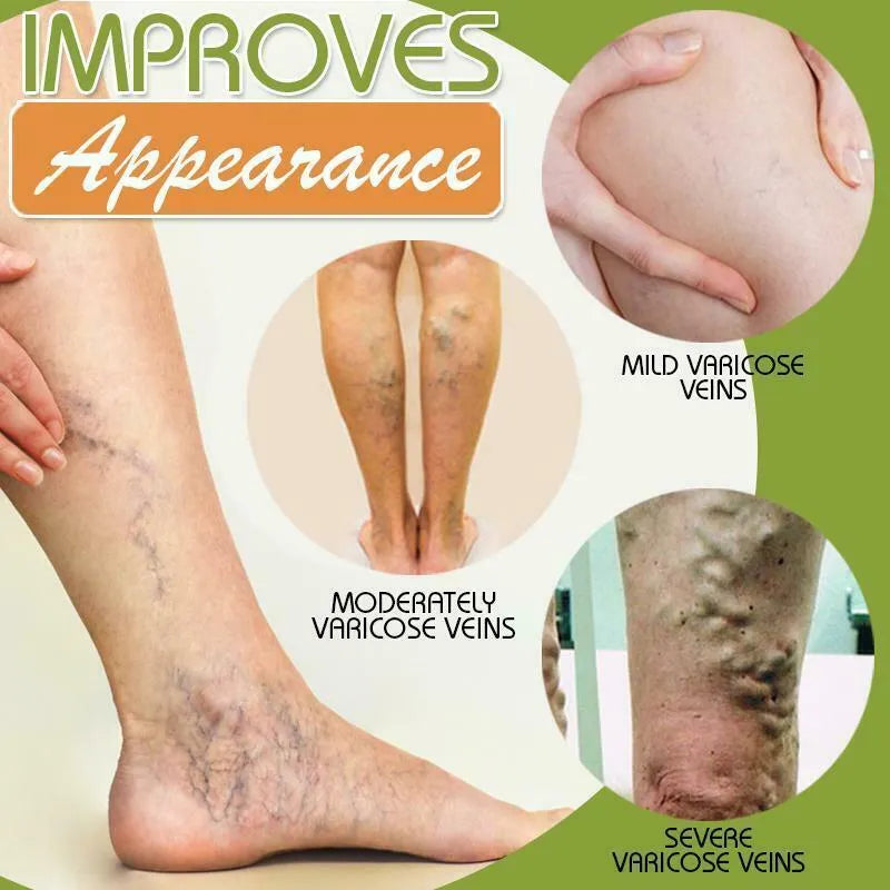 Varicose Veins Cream